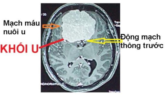 Cứu sống bệnh nhân bị u não to bằng quả trứng ảnh 1