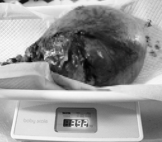 Phẫu thuật thành công cho bệnh nhân có khối u xơ tử cung nặng tới 4kg ảnh 2