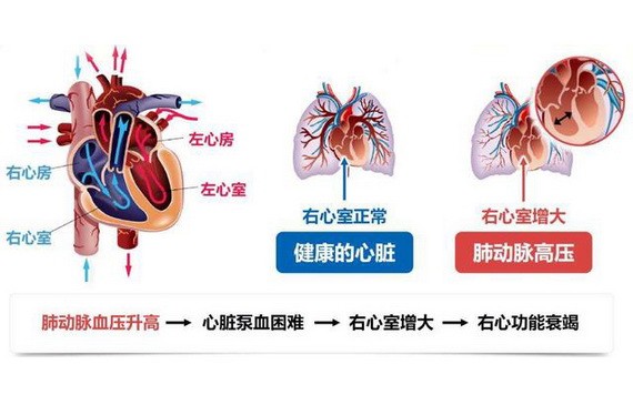 警惕肺動脈高壓帶來健康威脅 健康 飲食 華文西貢解放日報