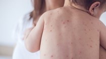HCMC records three cases of measles