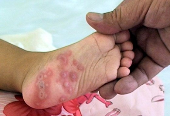 18 month old toddler in central province dies of HFM disease