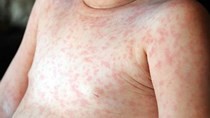 Cases of measles skyrocketing in Vietnam