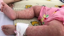 No death, but over 1,000 measles cases reported in Hanoi