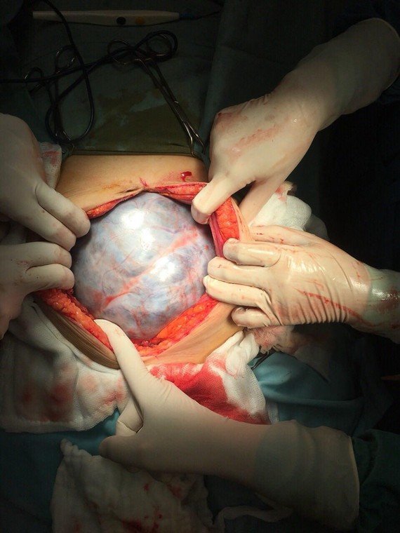 Hình ảnh khối u trong bụng bệnh nhân