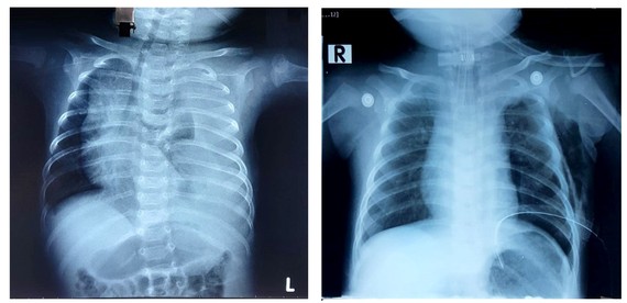 Phim chụp Xquang trước phẫu thuật của bệnh nhi phổi bên trái có nhiều dịch trắng xóa và phim chụp Xquang sau phẫu thuật
