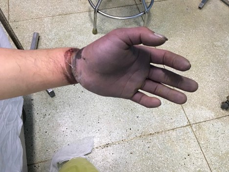 Vùng bàn tay và ngón tay của bệnh nhân tím, thiếu máu nuôi toàn bộ