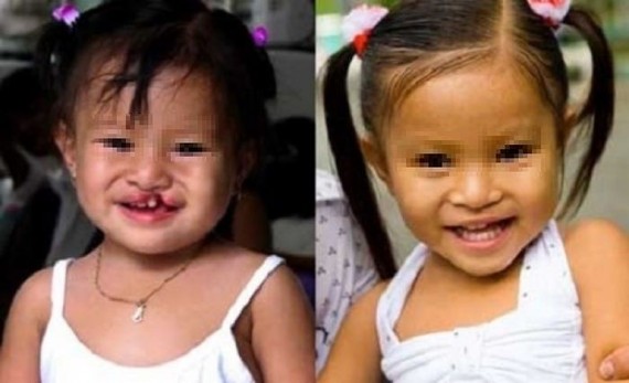 給39 唇顎裂兒童帶來幸福笑臉 時政 華文西貢解放日報 給39 唇顎裂兒童帶來幸福笑臉 時政 華文西貢解放日報