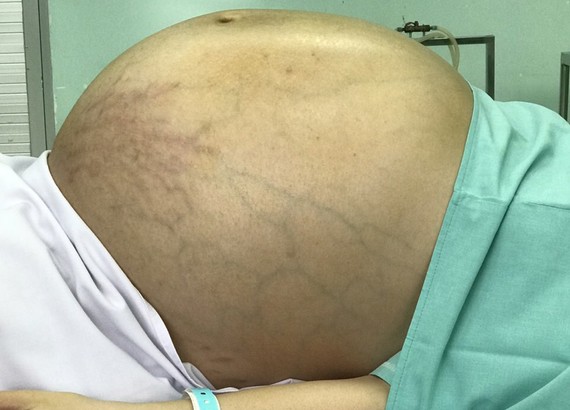 巨型卵巢腫瘤患者N.N.T.N 在手術前拍下的腹部照片。（圖源：醫院提供）
