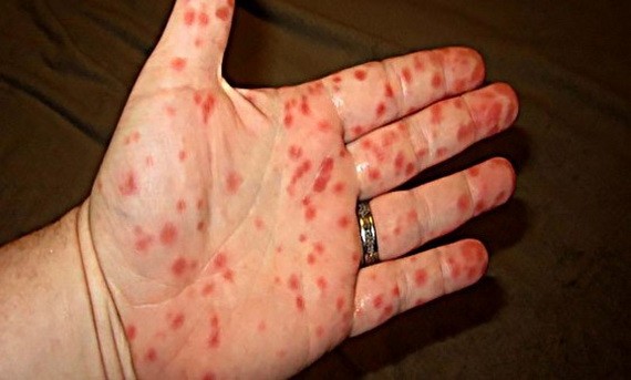 皮膚出現紅斑就是登革熱病的特徵跡象。