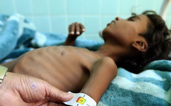 也門薩那，一名罹患營養不良的兒童正在醫院接受治療。（圖源：兒基會）
