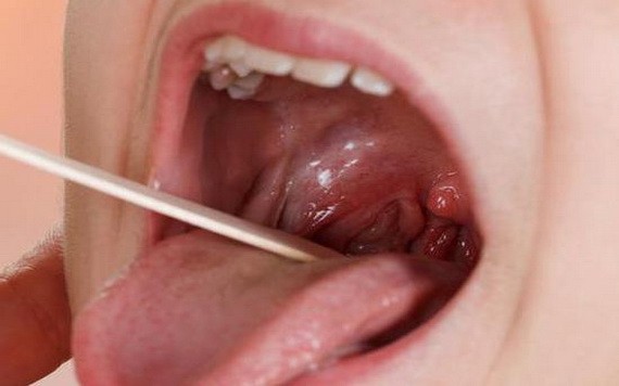 出現這５種情況 扁桃體還是別留了 健康 飲食 華文西貢解放日報