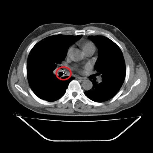 Dị vật ở lòng phế quản trung gian phổi phải qua hình ảnh chụp cắt lớp vi tính