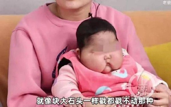 Bé gái bị tăng cân bất thường sau khi sử dụng kem và được truyền thông Trung Quốc gọi là "trẻ đầu to". Ảnh: shangyounews.