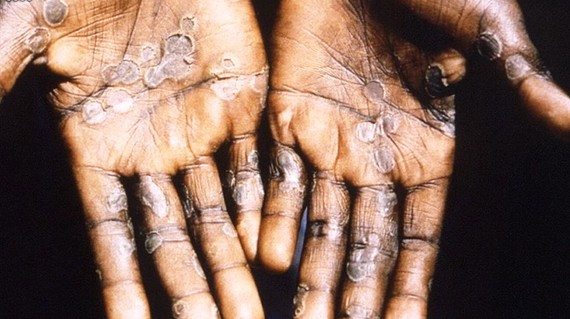 猴痘“類天花”在全球多國擴散