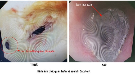 Lỗ dò thực quản - phế quản (ảnh trái) và thực quản - phế quản sau khi đặt Stent thực quản thành công
