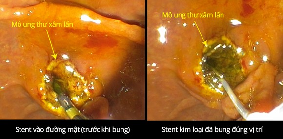 Cứu sống cụ bà bị ung thư tụy xâm lấn gây tắc mật ảnh 1