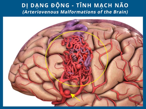 Nhập viện vì đau đầu, buồn nôn, không ngờ bị đột quỵ do xuất huyết não ảnh 1
