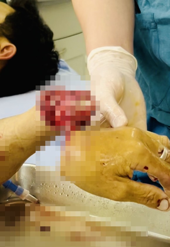 Nối thành công bàn tay bị máy xẻ gỗ cắt lìa ảnh 1
