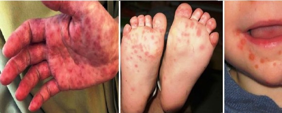Bộ Y tế yêu cầu khẩn cấp phòng chống dịch bệnh tay chân miệng tăng đột biến ảnh 1