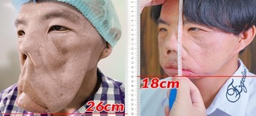 Gương mặt anh Mến sau 1 năm được bác sĩ Tú Dung điều trị thu gọn từ 26cm còn 18cm