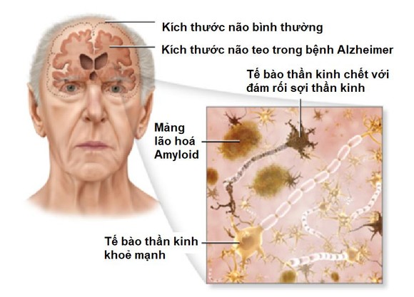 Cơ chế gây bệnh của bệnh Alzheimer và mức độ teo ở người bệnh Alzheimer