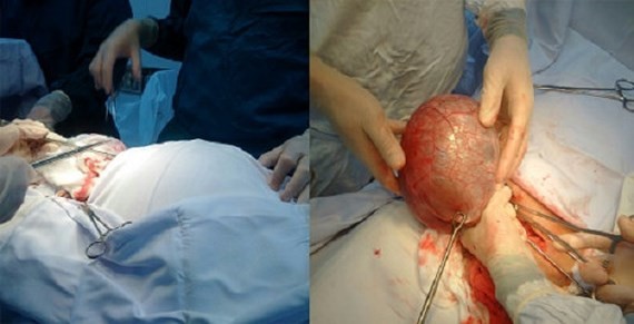左圖：阮氏Ng.患者接收手術中。右圖：超大卵巢囊腫被成功摘除。（圖源：VTCNEWS）