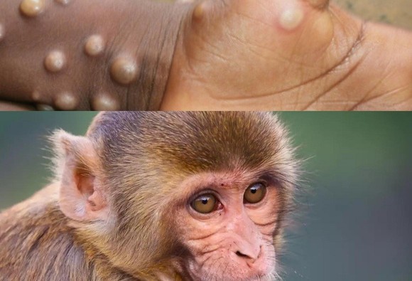 Đậu mùa khỉ lây từ người sang người qua quan hệ tình dục, lưu ý 3 thể bệnh ảnh 1