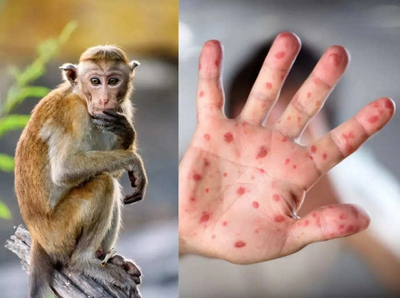 Việt Nam ráo riết chuẩn bị vaccine, thuốc điều trị đậu mùa khỉ ảnh 2