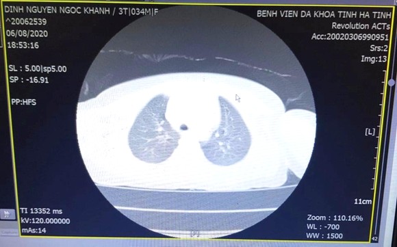 Hình ảnh dị vật thông qua chụp CT- Scanner của bệnh nhi K.