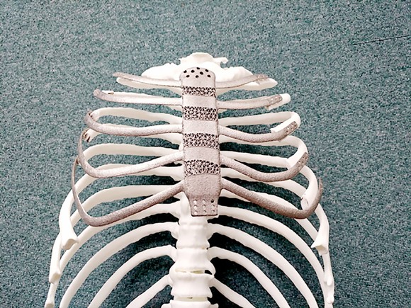 Ghép xương công nghệ in 3D