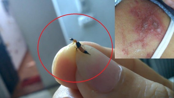 Kiến ba khoang (hình lớn) và một người bị viêm da dị ứng do độc chất từ kiến ba khoang (hình nhỏ)