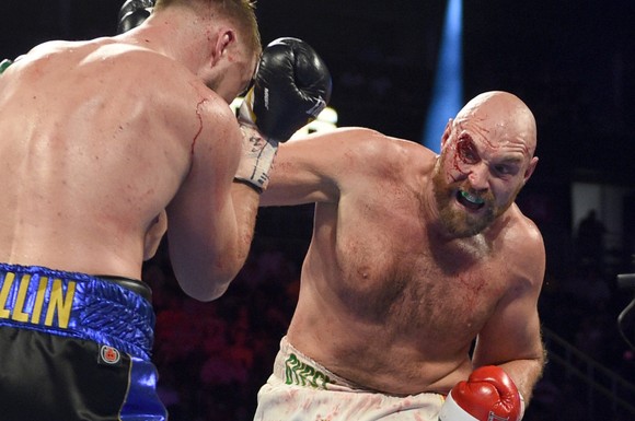 Quyền Anh: Fury “giận dữ” trả giá cho chiến thắng - rách chân mày, máu chảy đầy mặt phải nhập viện ảnh 3