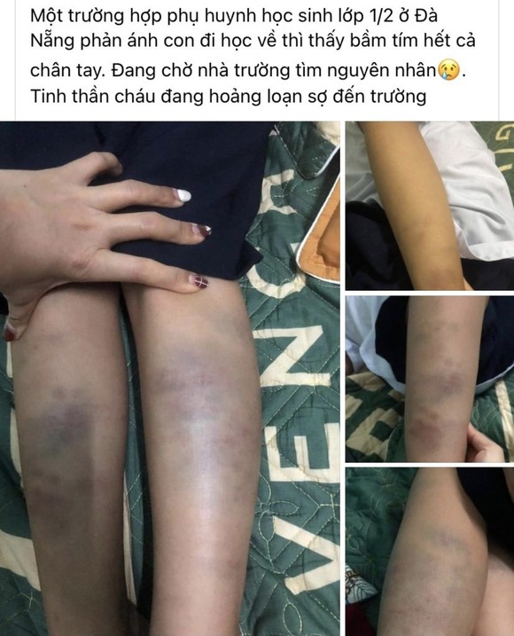 Đà Nẵng: Thực hư vụ học sinh bị đánh bầm tím ảnh 1