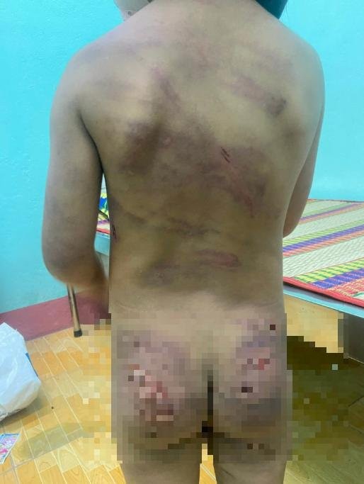 Bé gái 7 tuổi tại Bình Phước nghi bị bạo hành đang được chữa trị ảnh 1