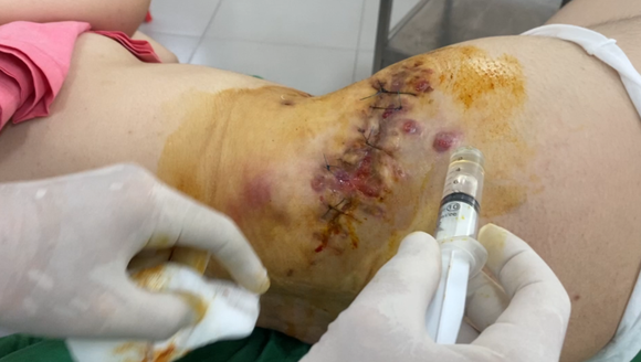 Hoại tử vì tiêm thuốc tan mỡ bụng, nữ bệnh nhân phải phẫu thuật 5 lần ảnh 1