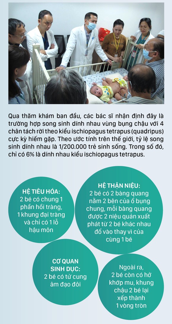 Hành trình của cặp song sinh dính liền hiếm gặp nhất Việt Nam Diệu Nhi - Trúc Nhi ảnh 2