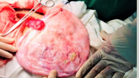Bệnh viện tuyến quận mổ thành công bệnh nhân mang khối u 5kg ảnh 1