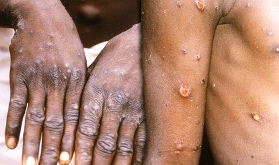 Vietnam closely monitors people returning from 12 countries with monkeypox ảnh 2